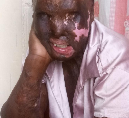 Woman Pours Acid On Cousin Over Business, Remanded