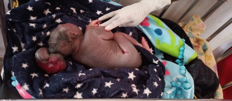 Couple In Gulu Traumatized After Giving Birth To Baby With Deadly Encephalocele Disease