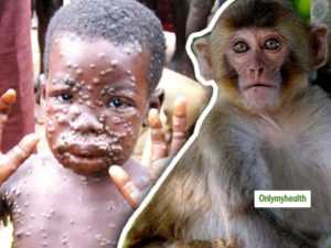 Biological Warfare: World On Alert Again As Monkeypox Sweeps Over U.S, Europe